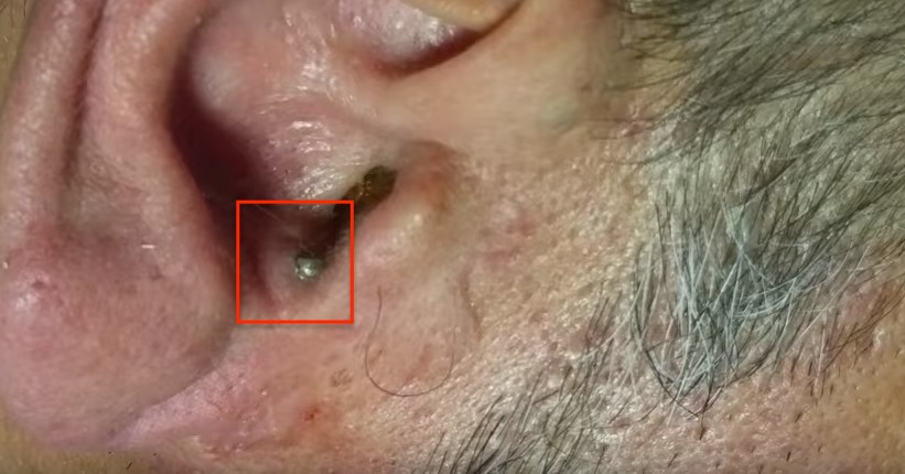 Nota Una Strana Pallina Nell Orecchio La Dottoressa Interviene Per Rimuoverla