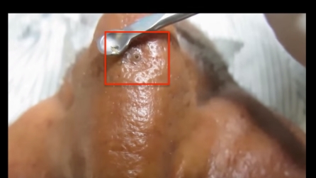 3 grado di unacne di una fotografia