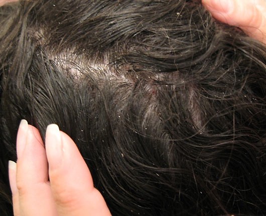 Quest Uomo Ha La Testa Infestata Dai Pidocchi Il Video Da Brividi