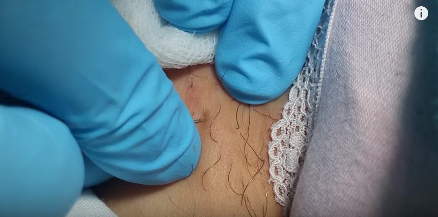Come Rimuovere un Pelo Incarnito: 10 Passaggi Epilatore laser che e meglio