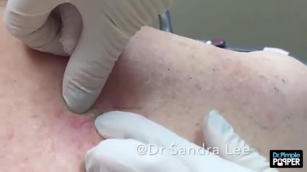 Dermatologista espreme cravo grande, algo surpreendente sai