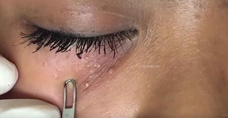 La mesotherapy per problema affronta risposte di fotografia della pelle