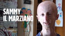 Sammy Basso, una vita con la progeria: "Studio una ricerca per fare del bene agli altri"