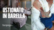 Giovane ustionato gravemente, in barella da giorni al Cardarelli