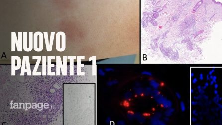 Covid, scoperto nuovo paziente 1 italiano: è una donna milanese positiva a novembre 2019